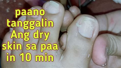 Mga Paraan Kung Paano Tanggalin Ang Kuntil O Skin Tag.